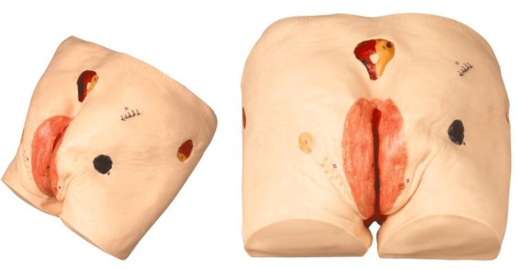 高级压疮(褥疮)护理模型
