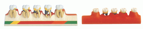 牙周病分类模型-上海佳悦公司:021-63283651中国领先的医学教学模型设备制造厂家